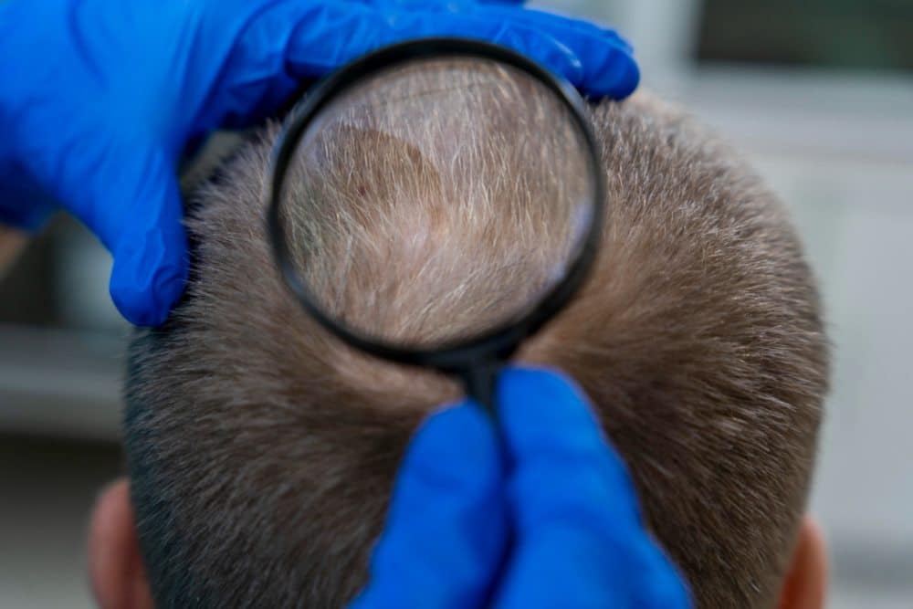 Médico estético viendo con lupa el cuero cabelludo de un hombre al que le falta pelo en la zona de la coronilla