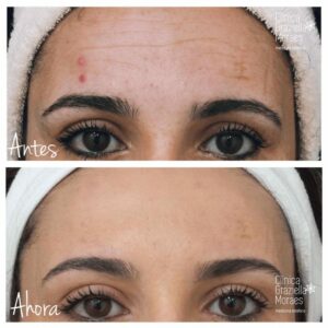 Tratamiento medicina estética con Neuromodulador - Imagen antes y después de 3 semanas