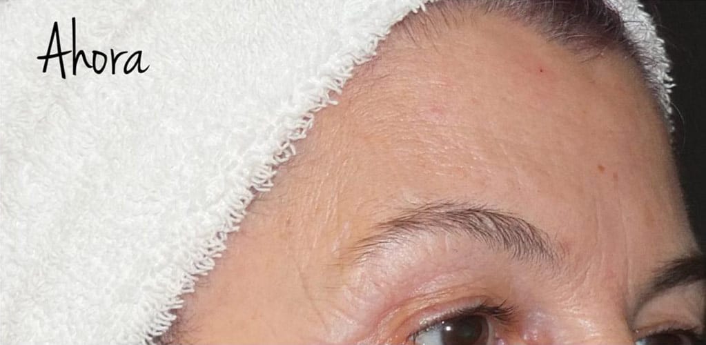 Detalle de frente de mujer después de tratamiento medicina estética con neuromoduladores para reducir arrugas