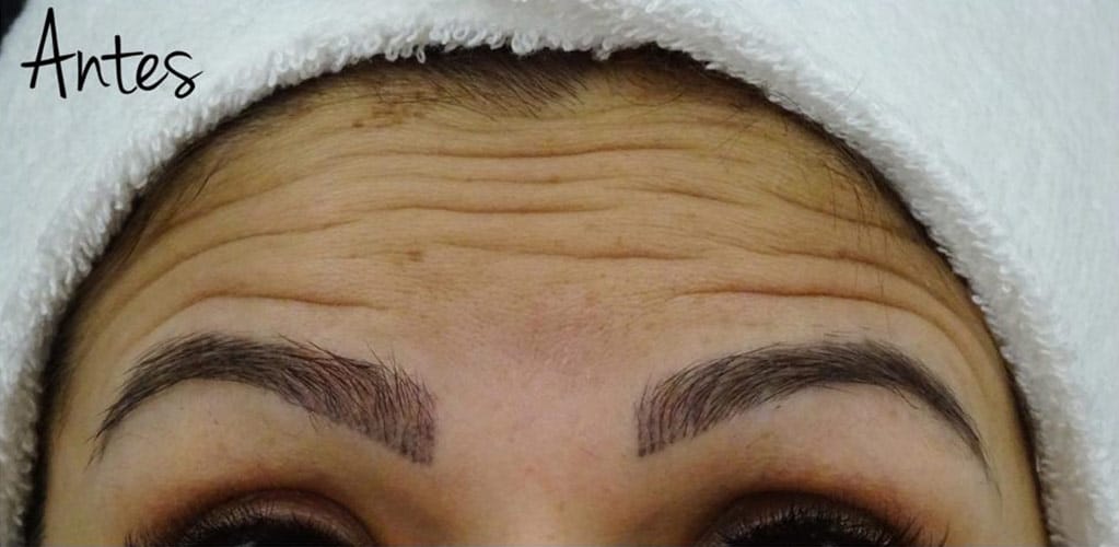 Detalle de frente de mujer antes de tratamiento medicina estética con neuromoduladores para reducir arrugas