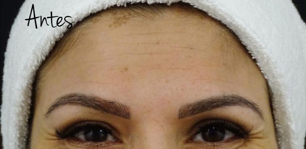 Detalle de frente de mujer antes de tratamiento medicina estética con neuromoduladores para reducir arrugas