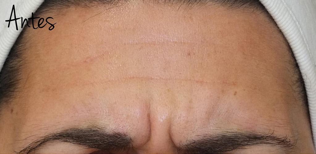 Detalle de frente de mujer antes de tratamiento medicina estética con neuromoduladores para reducir arrugas