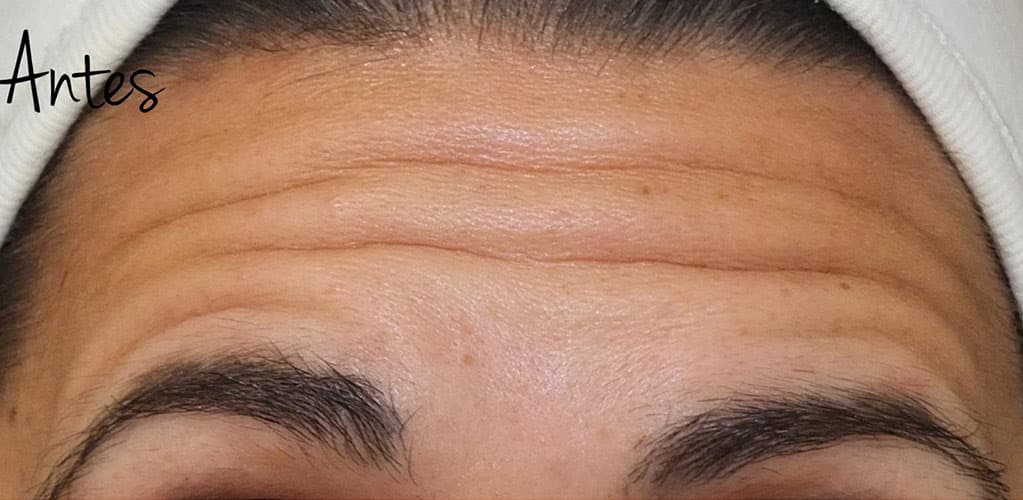 Detalle de frente de mujer antes de tratamiento medicina estética con neuromoduladores y ácido hialurónico para reducir arrugas