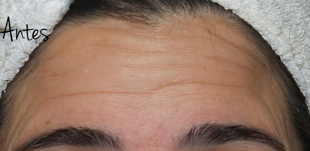 Detalle de frente de mujer antes de tratamiento medicina estética con neuromodulador y ácido hialurónico para reducir arrugas