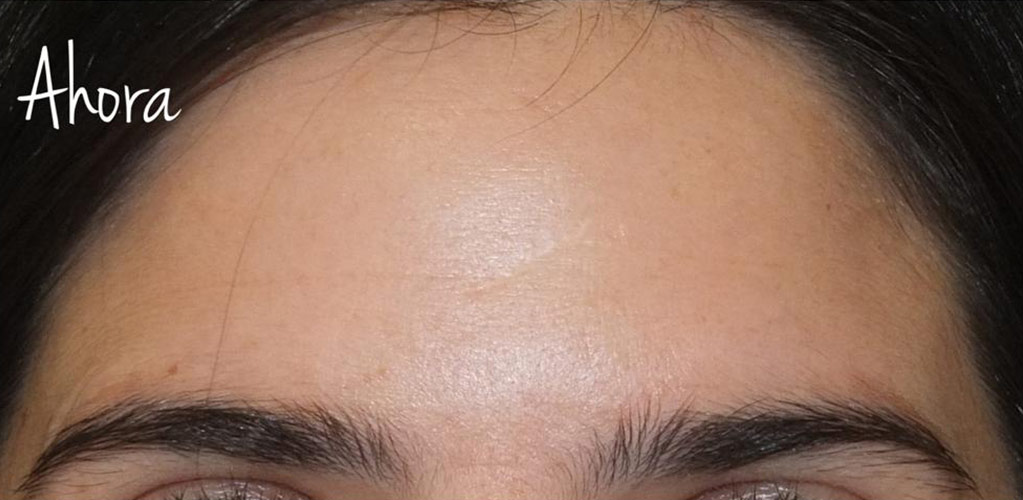 Detalle de frente de mujer después de tratamiento medicina estética con neuromoduladores y ácido hialurónico para reducir arrugas